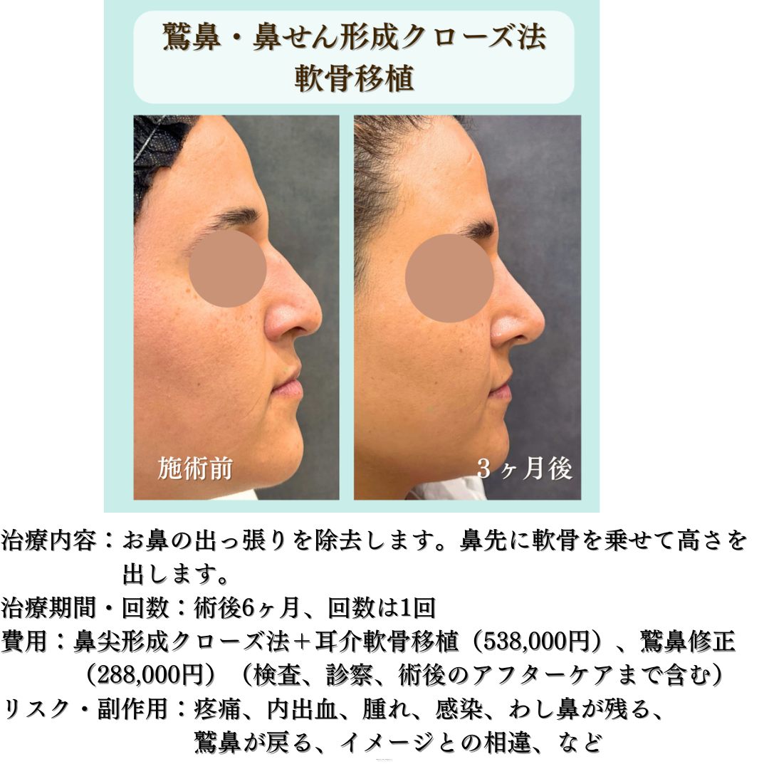 わし鼻とびせん形成クローズ法＋軟骨移植の症例です💁