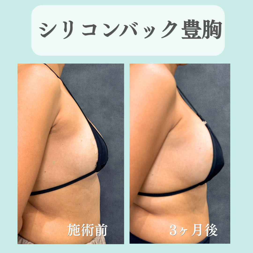 バック豊胸の症例です☺️