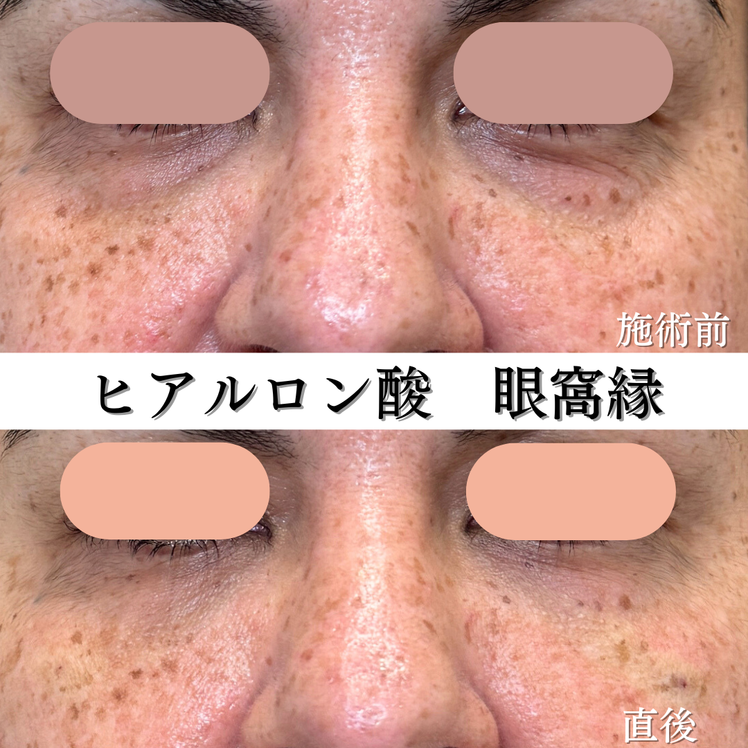 眼科縁ヒアルロン酸の症例です💡