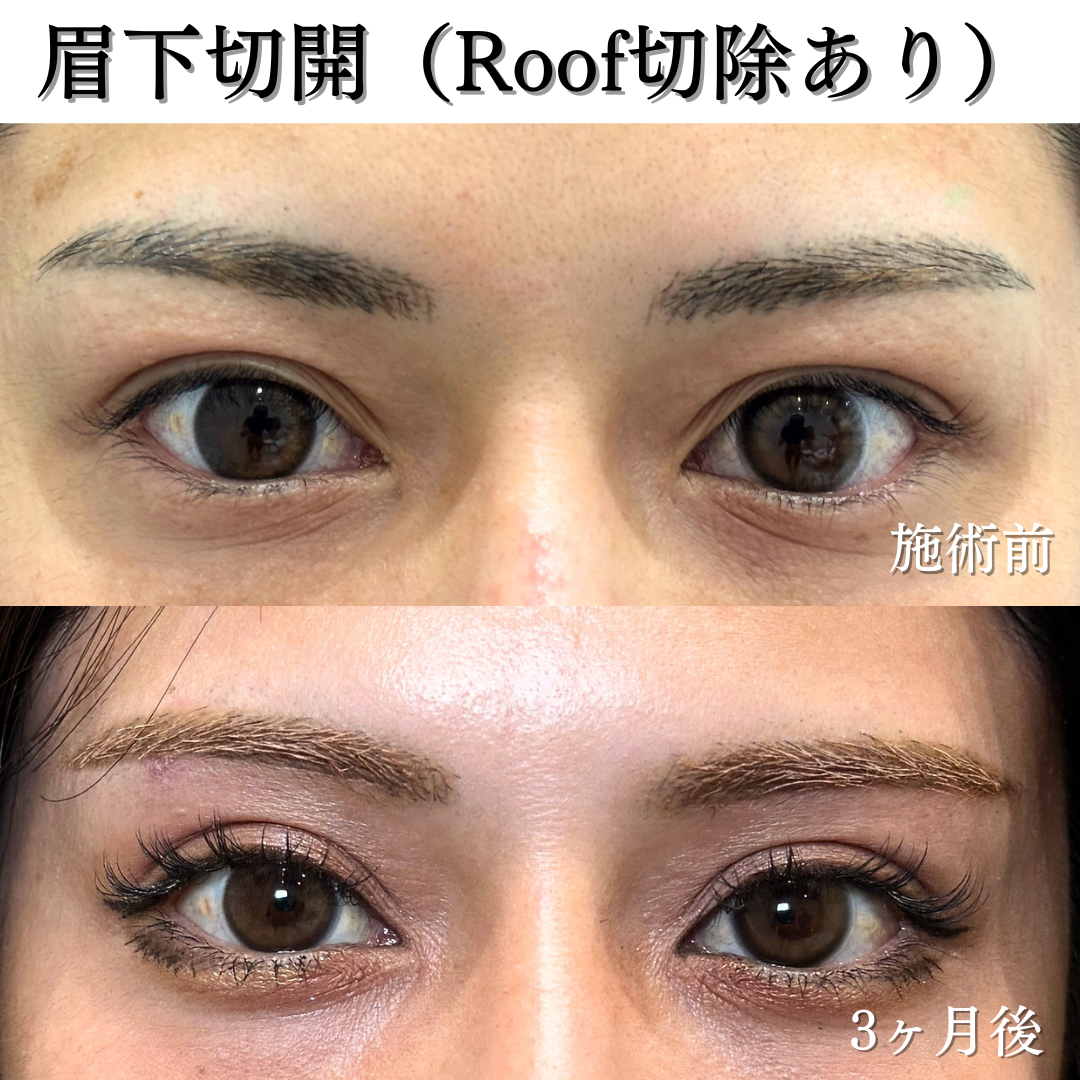 眉下切開の症例です💁♀️