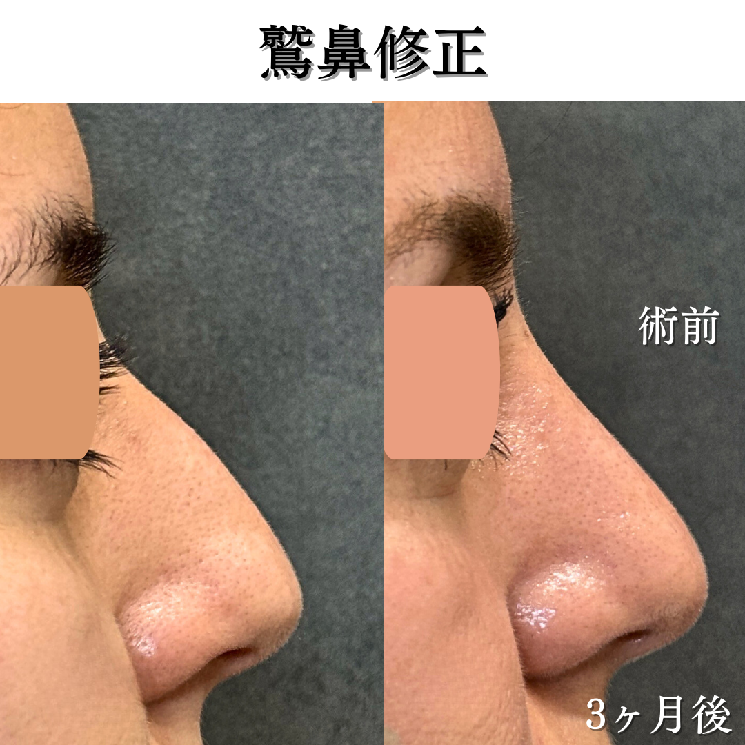 わし鼻修正の症例です💁