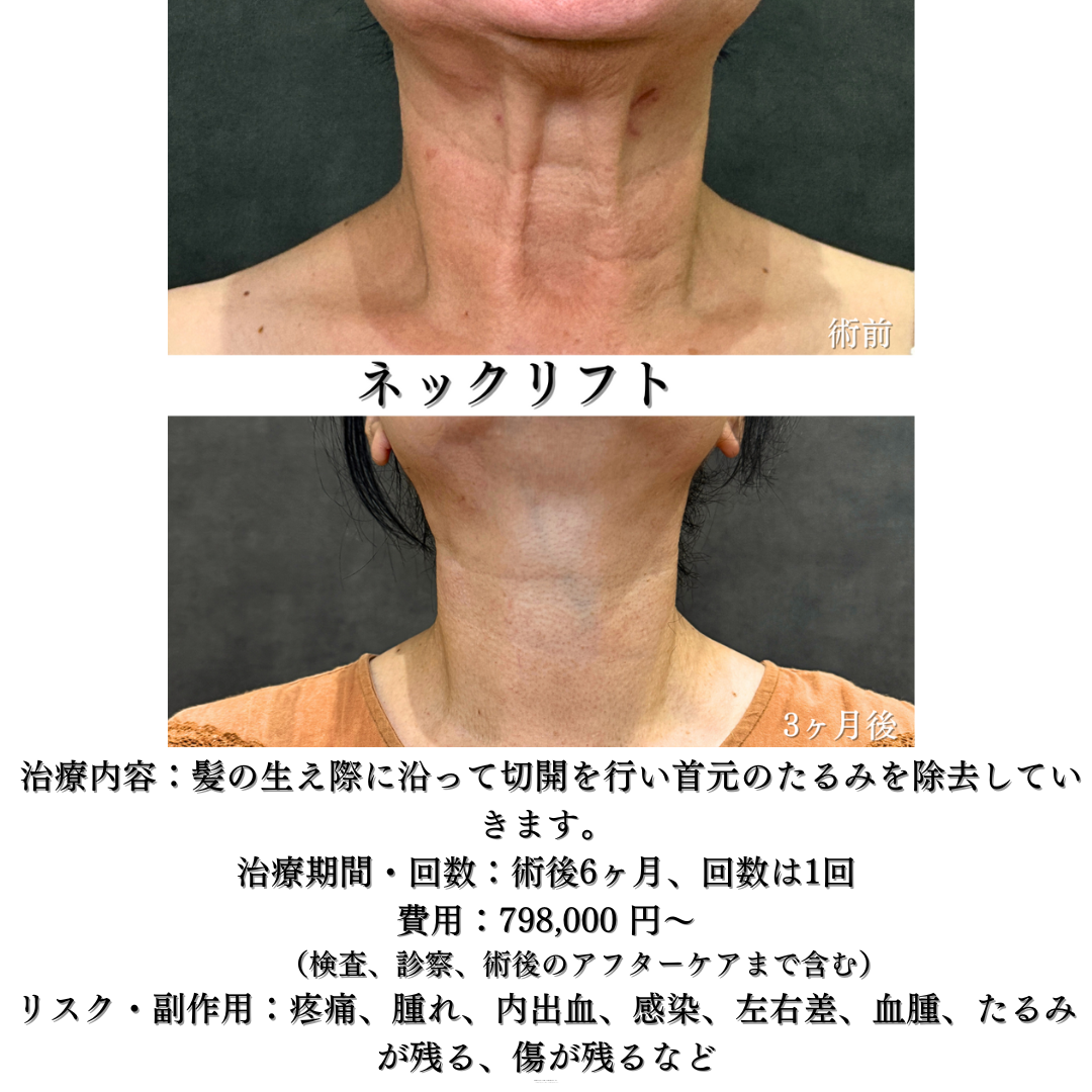 ネックリフトの症例です✨