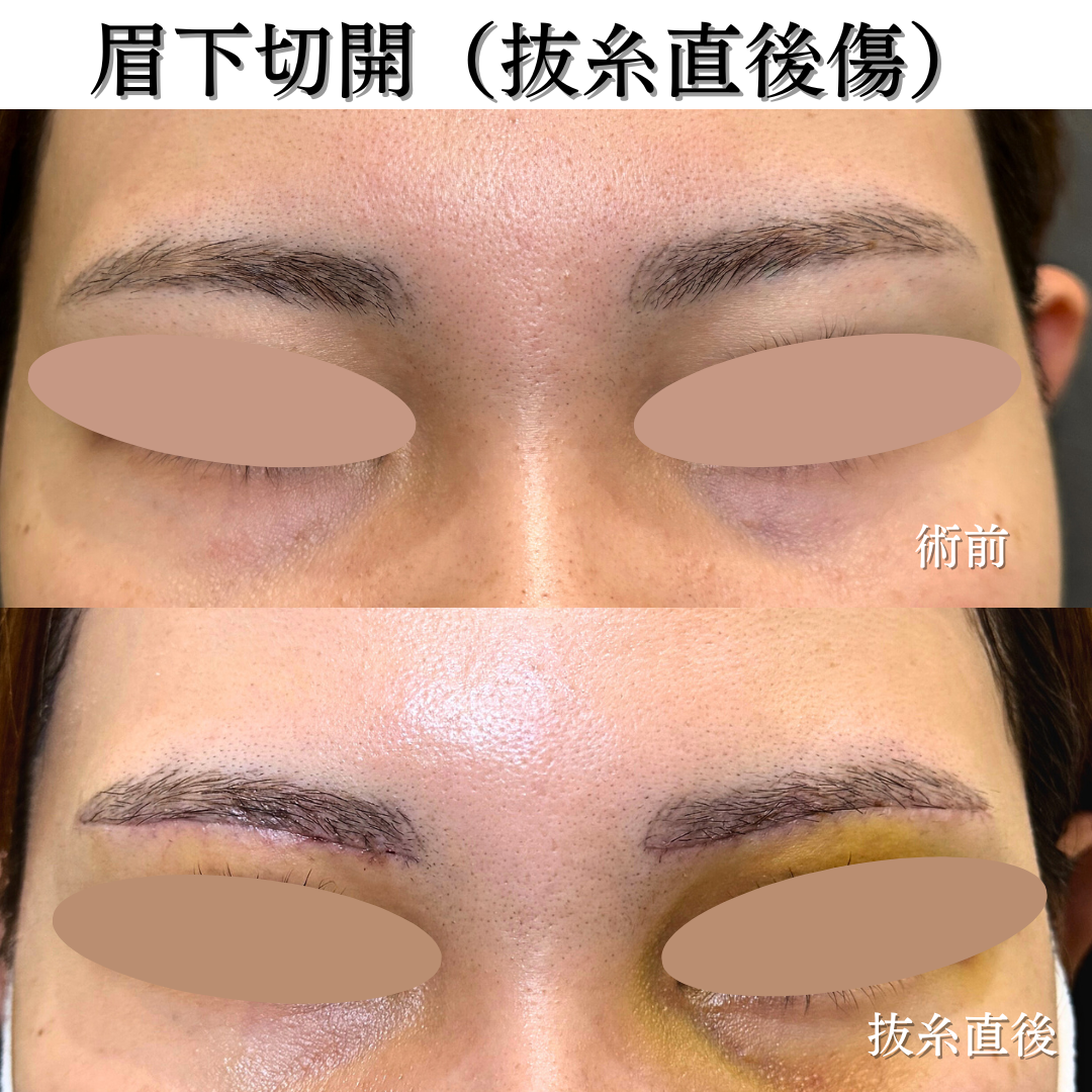 眉下切開の症例です💁♀️
