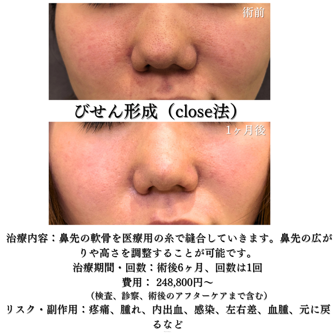 びせん形成close法＋鼻孔縁挙上の症例です💁‍♀️