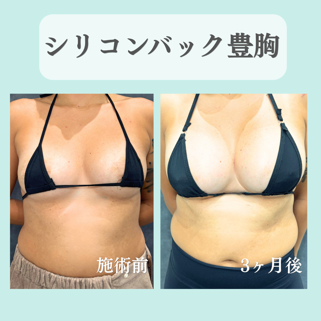 バック豊胸の症例です☺️