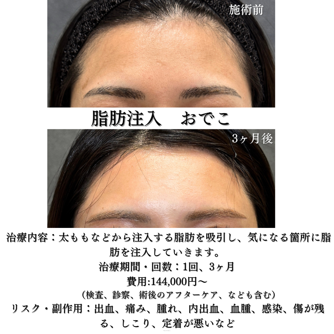 額、こめかみ、法令線の脂肪注入の症例です💁
