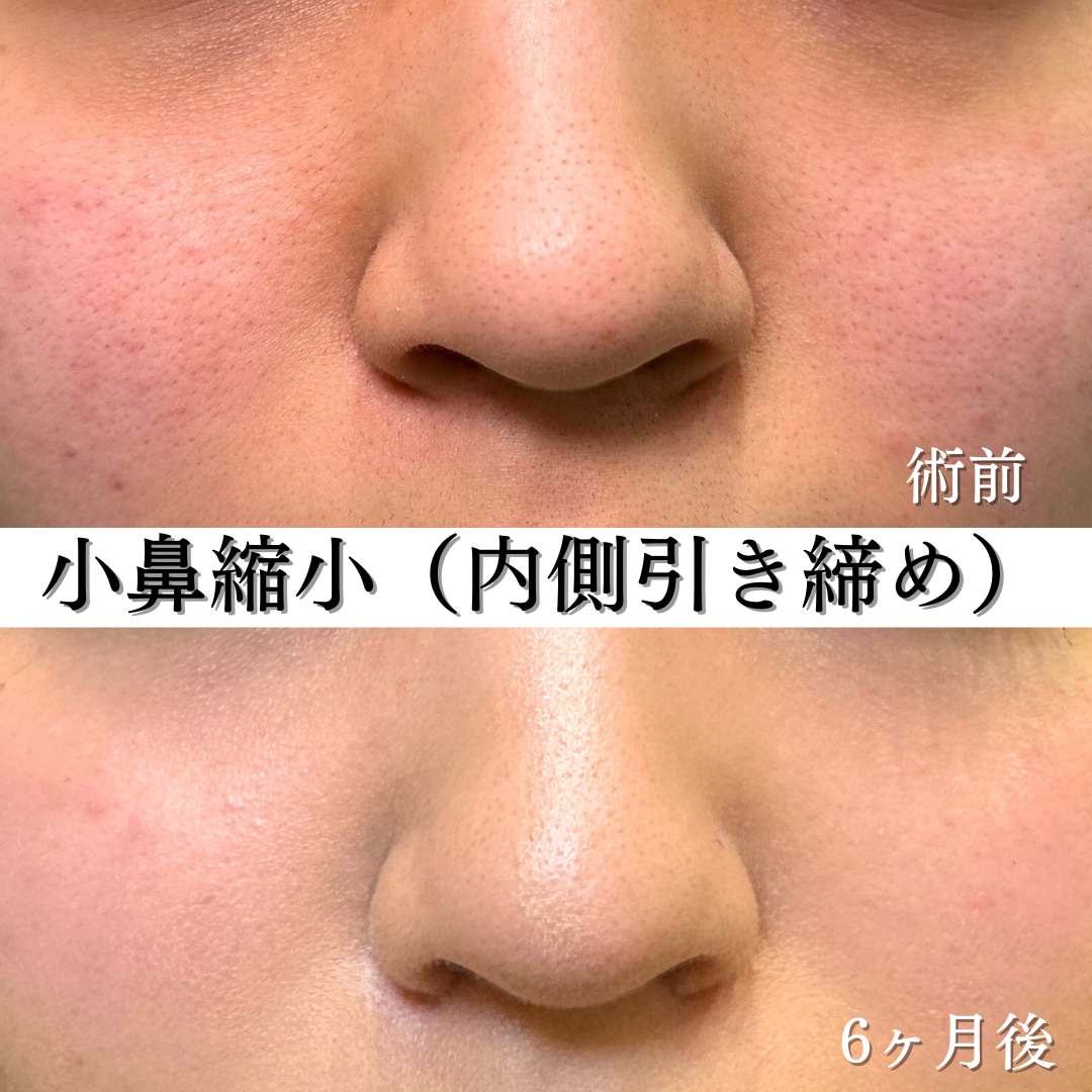 わし鼻修正+小鼻縮小の症例です💁♀️