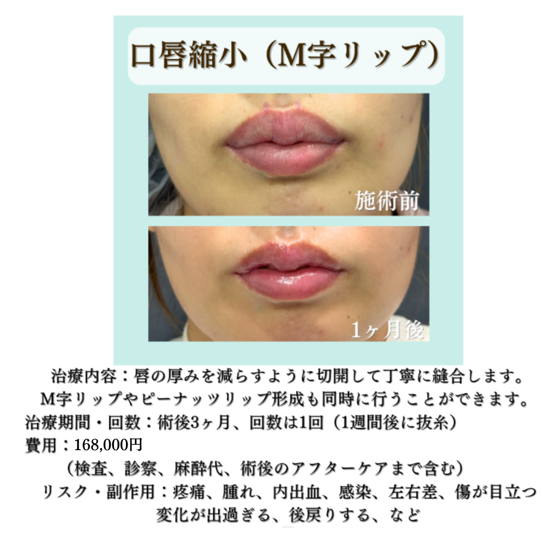 口唇縮小（M字リップ形成）の症例です💁