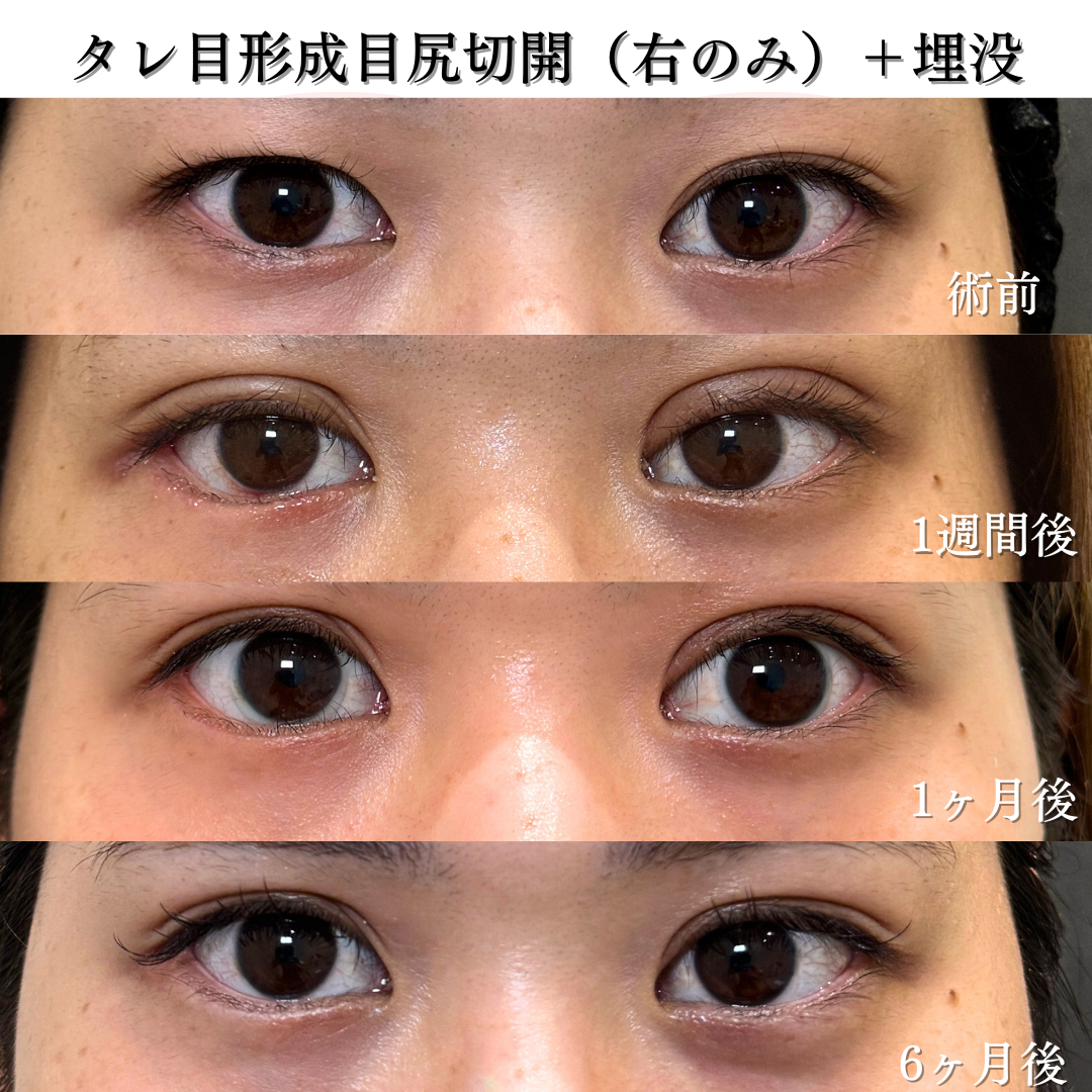 右目のグラマラス形成の症例です💡