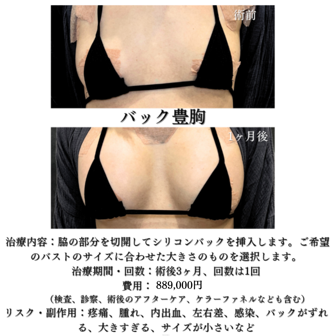 バック豊胸の症例です💡