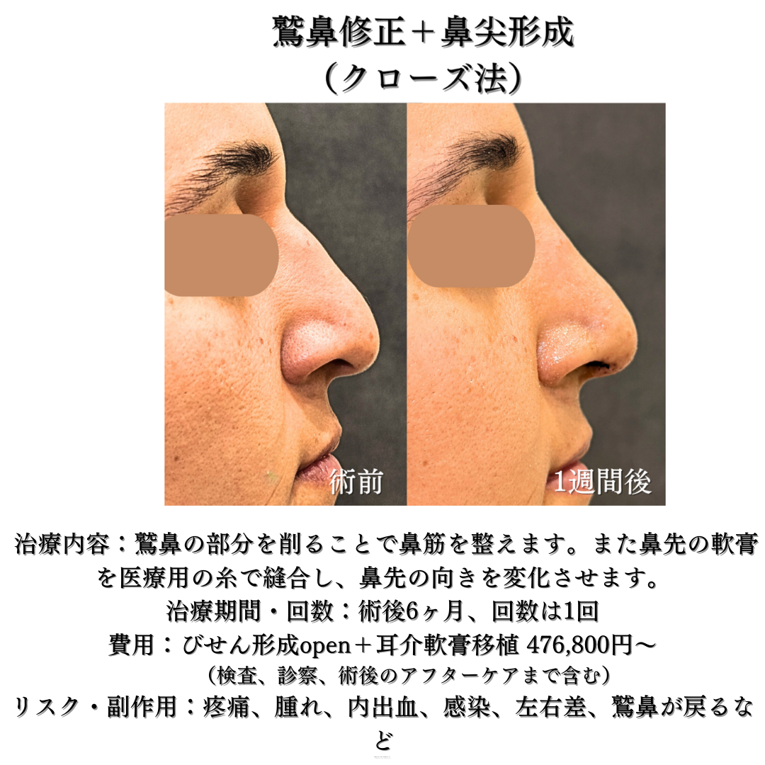 わし鼻修正+鼻尖形成クローズ法の症例です💁