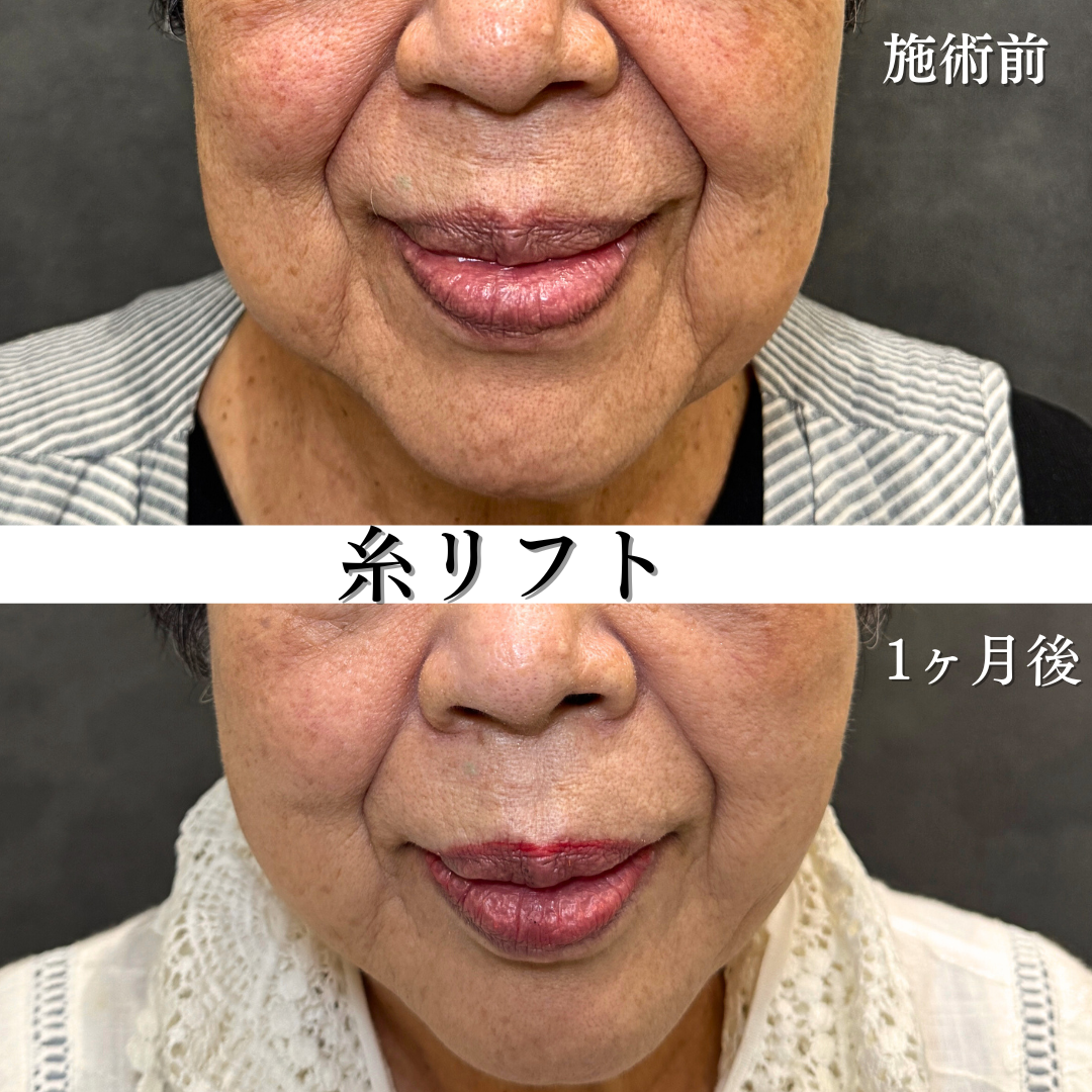 糸リフト