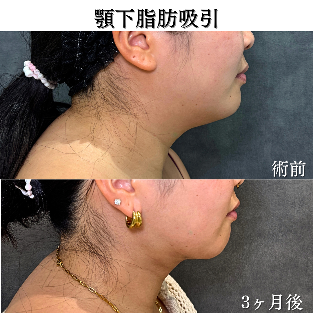 顎下脂肪吸引の症例です💁