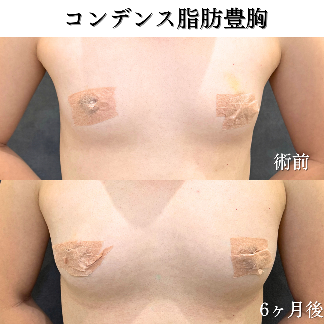 コンデンス脂肪豊胸の症例です✨