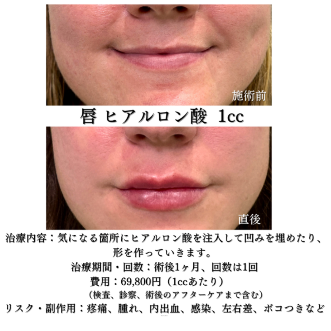 唇ヒアルロン酸（ボリフト1cc）の症例です💁