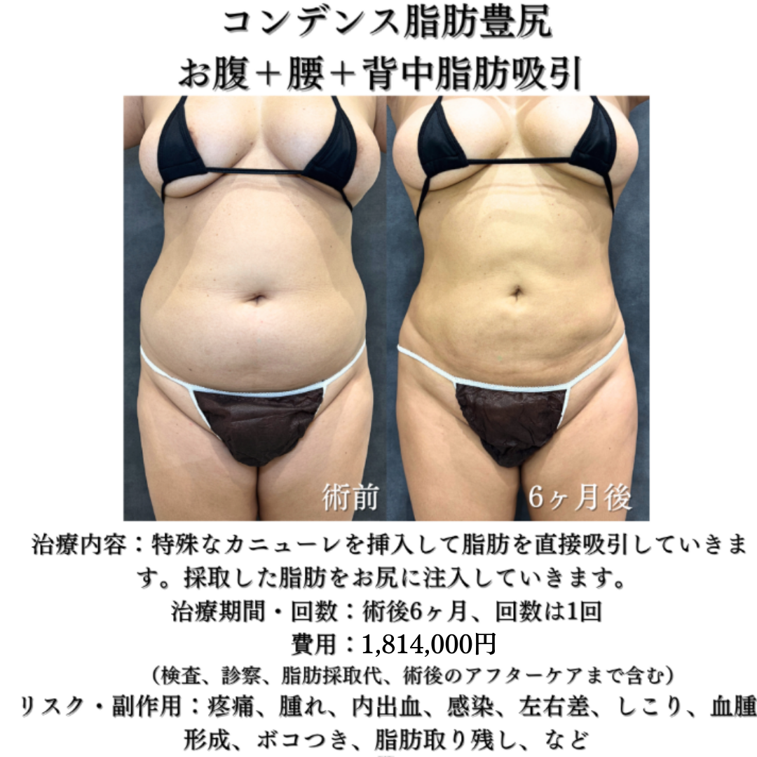 コンデンス脂肪豊尻、お腹＋腰＋背中脂肪吸引の症例です💁