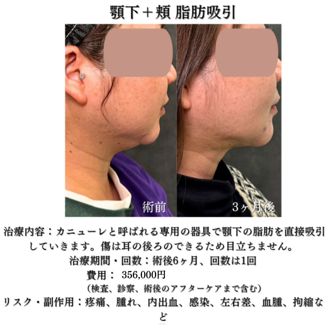 顎下脂肪吸引の症例です💁
