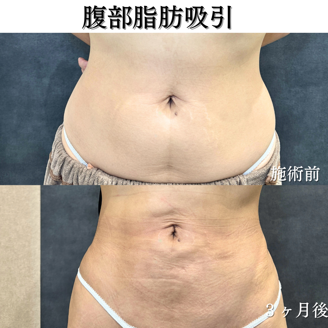 腹部脂肪吸引の症例です💡