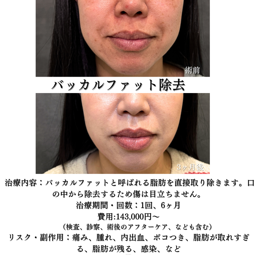 バッカルファット除去の症例です💡