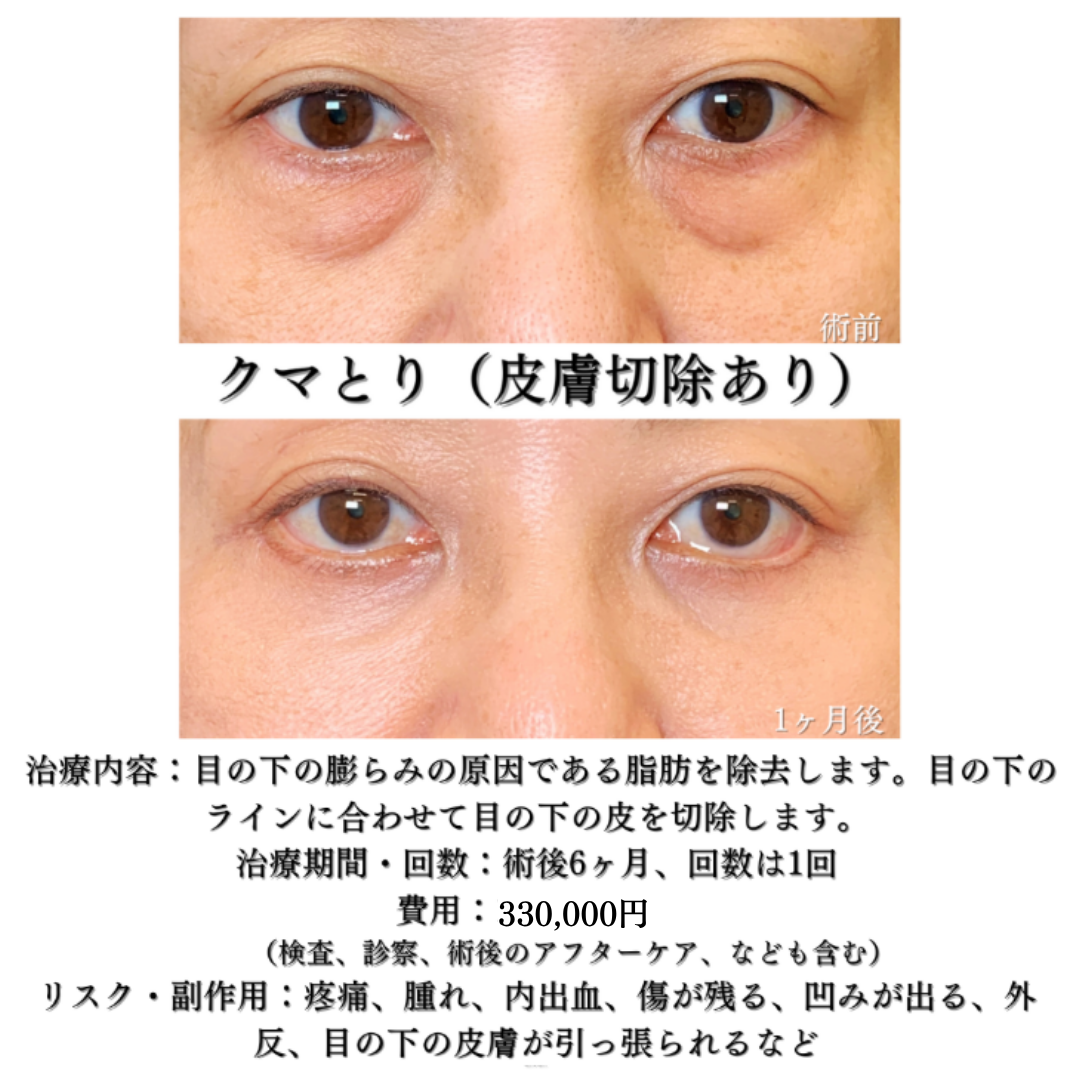 目の下のクマとり（皮膚切除＋脂肪とり）