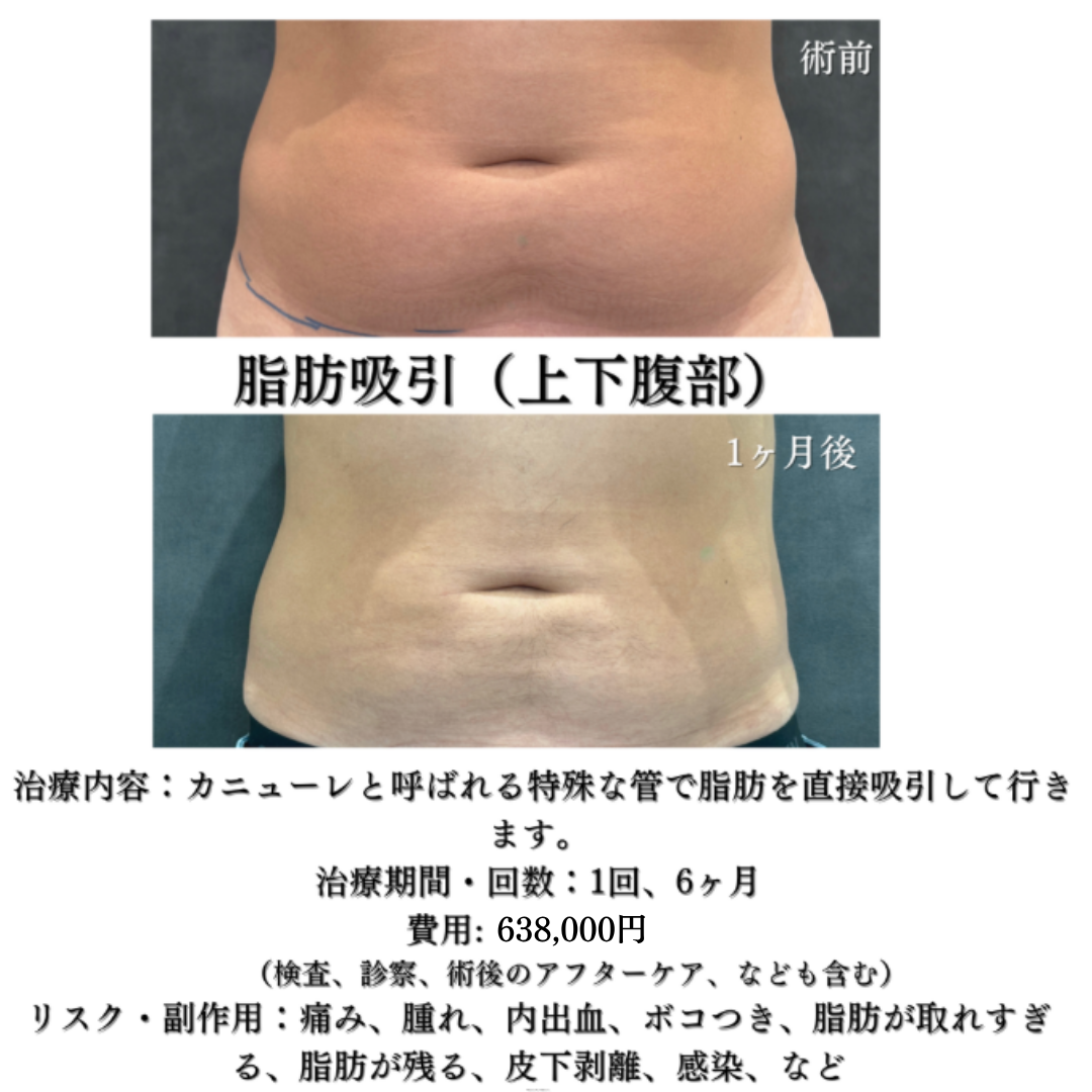 腹部脂肪吸引の症例です✨