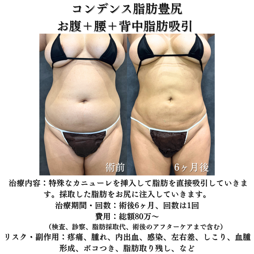コンデンス脂肪豊尻、お腹＋腰＋背中脂肪吸引の症例です💁