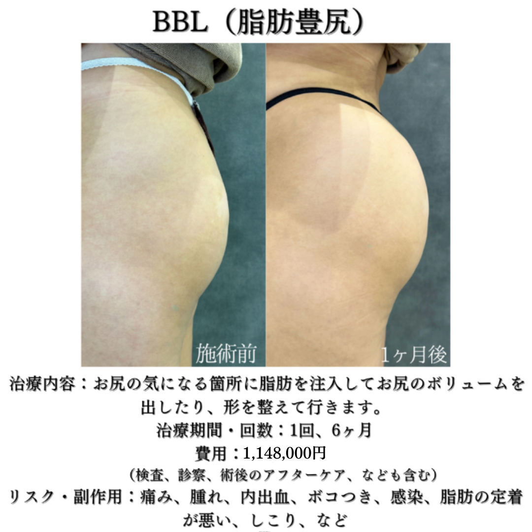 コンデンス脂肪豊尻（BBL）の症例です💁‍♀️