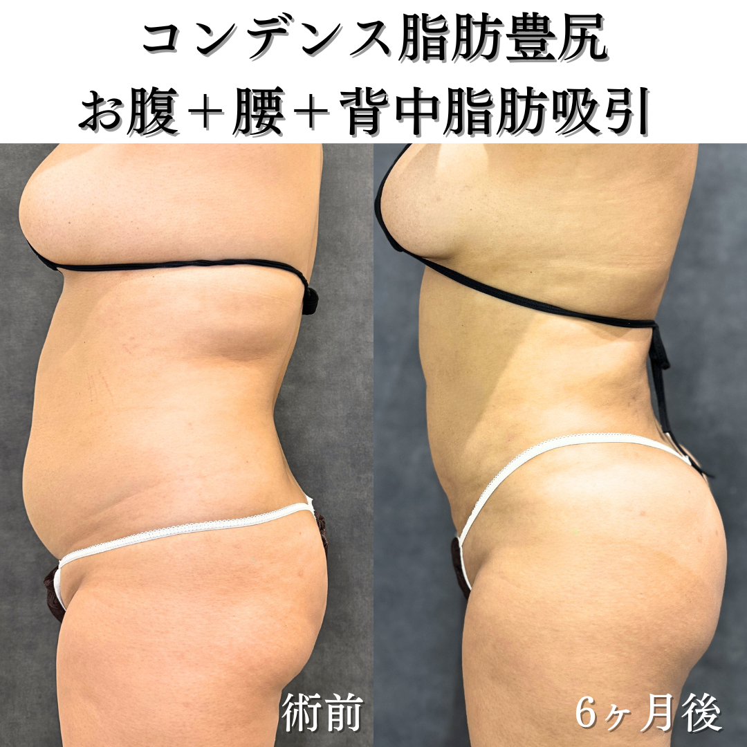 コンデンス脂肪豊尻、お腹+腰+背中脂肪吸引の症例です💁