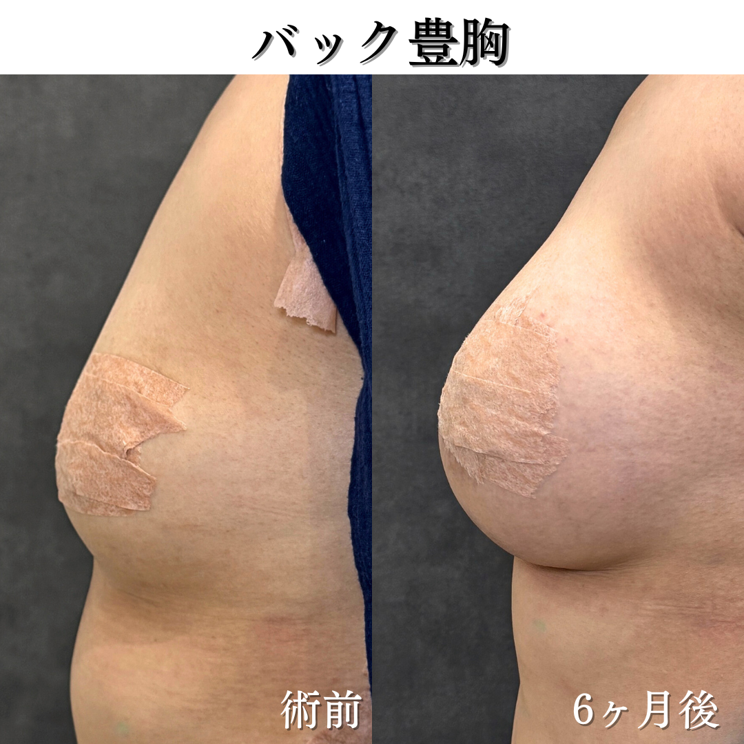 バック豊胸の症例です✨