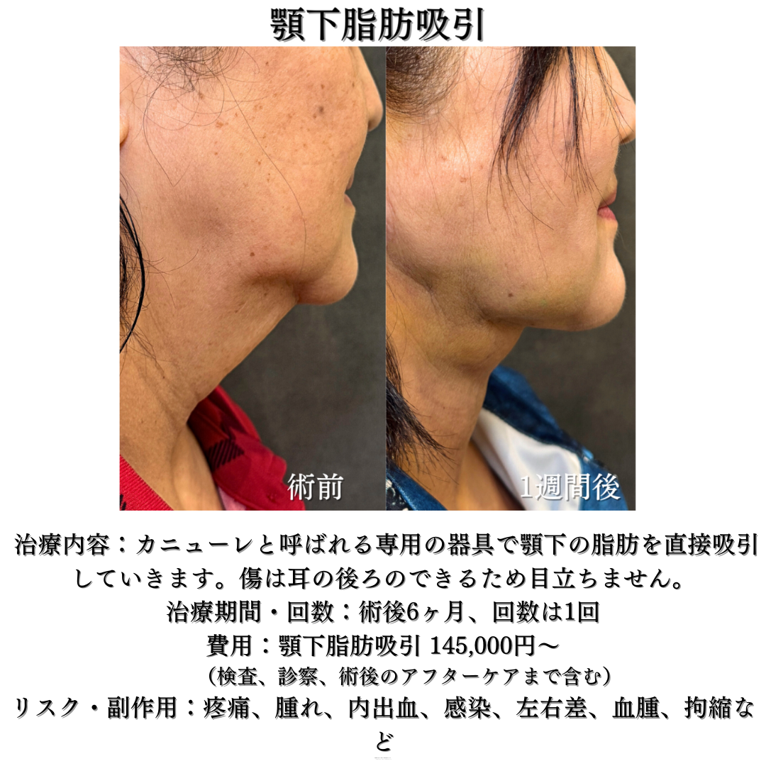 顎下脂肪吸引の症例です💁