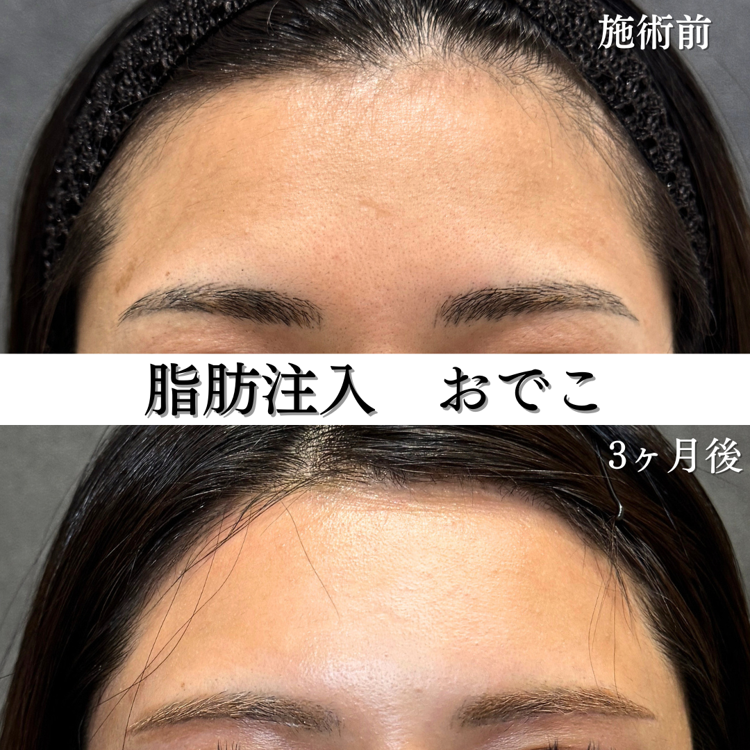 額、こめかみ、法令線の脂肪注入の症例です💁