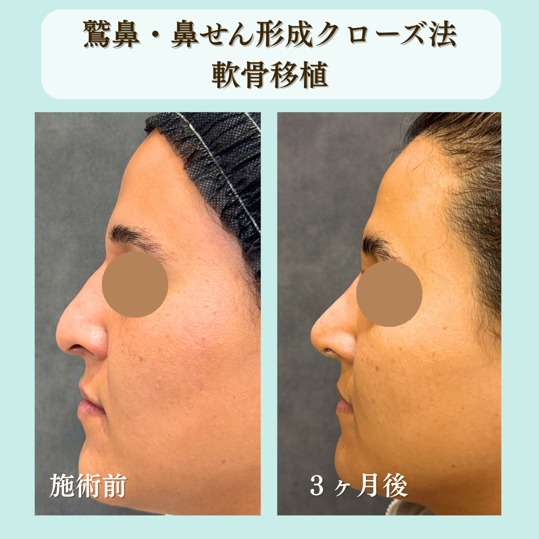 わし鼻とびせん形成クローズ法＋軟骨移植の症例です💁