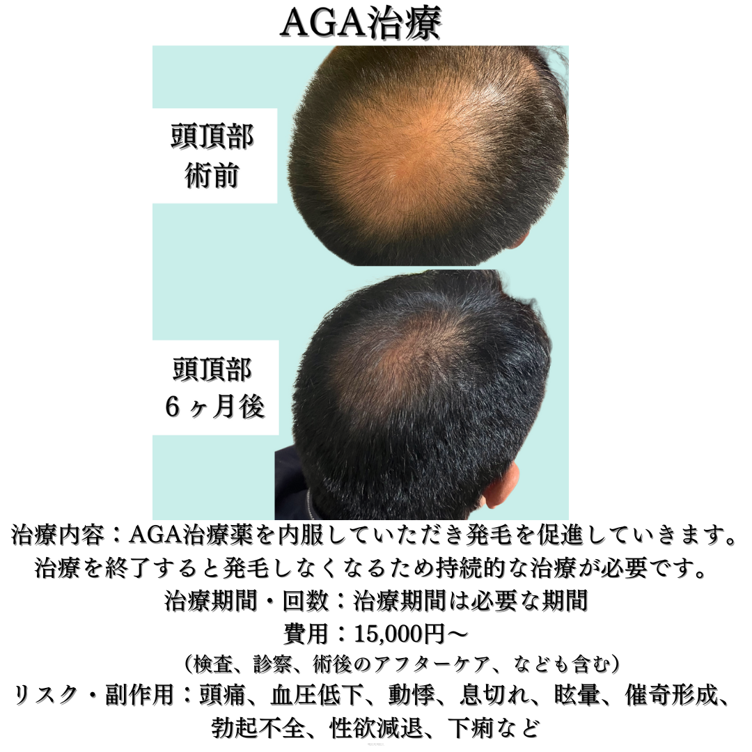 AGA治療（2剤併用）