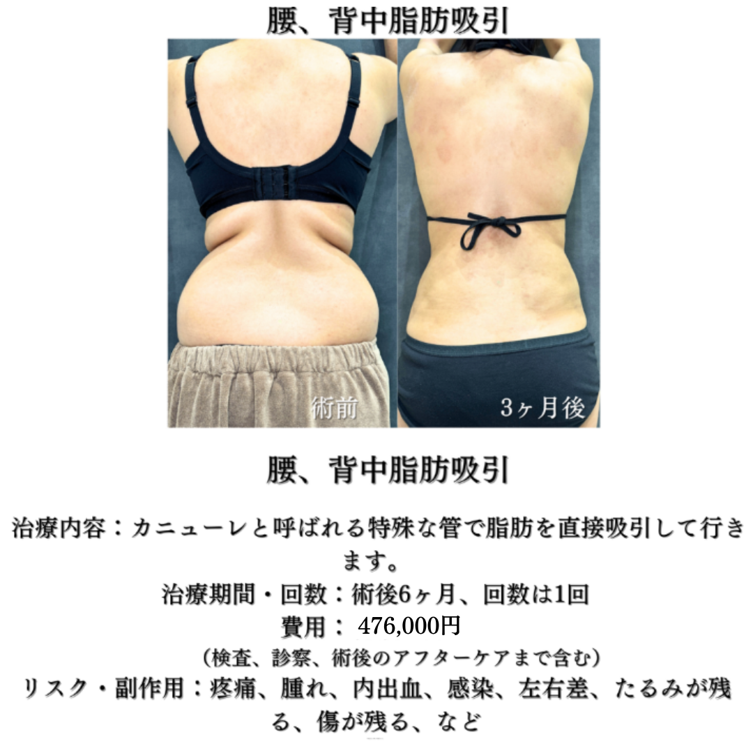 腰とウエスト、背中の脂肪吸引の症例です💁