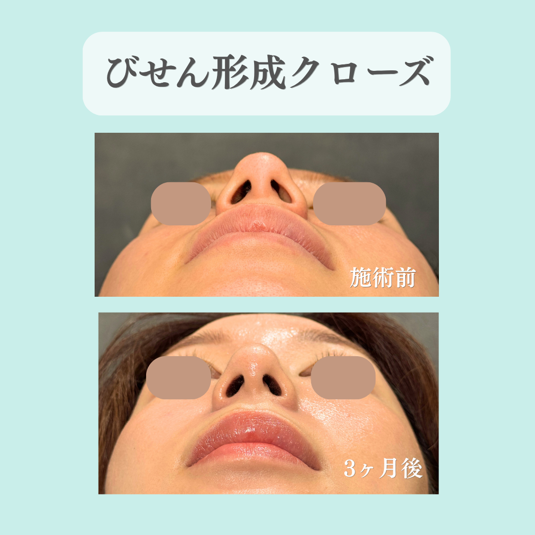 鼻尖形成クローズ法の症例です💁