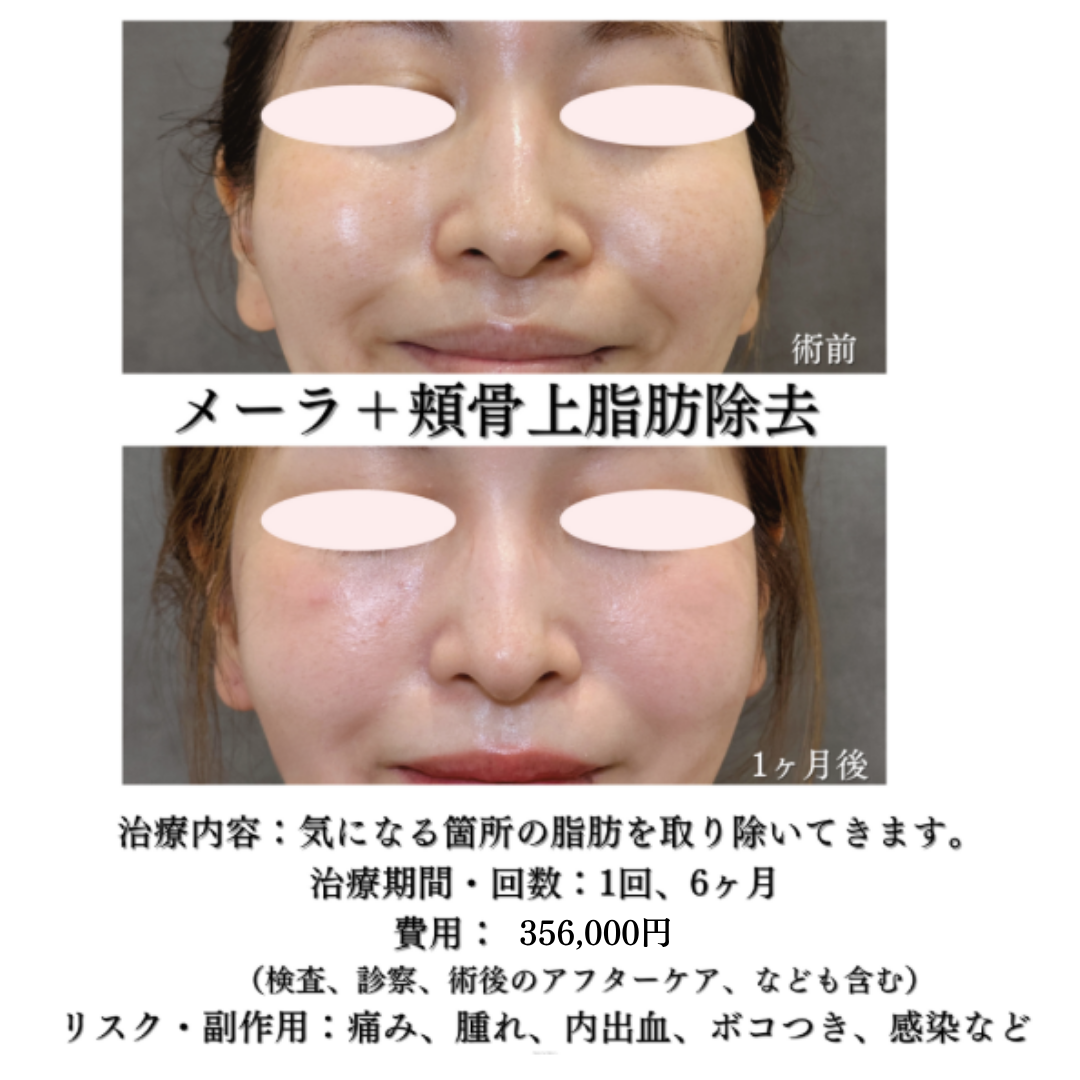 メーラーファット除去と頬骨上脂肪吸引注射