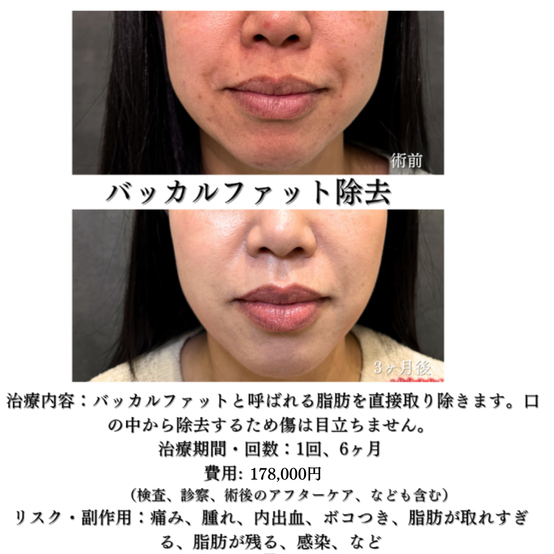 バッカルファット除去の症例です💡