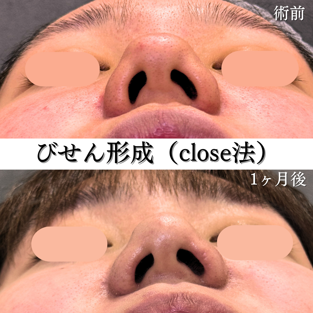 びせん形成close法＋鼻孔縁挙上の症例です💁‍♀️