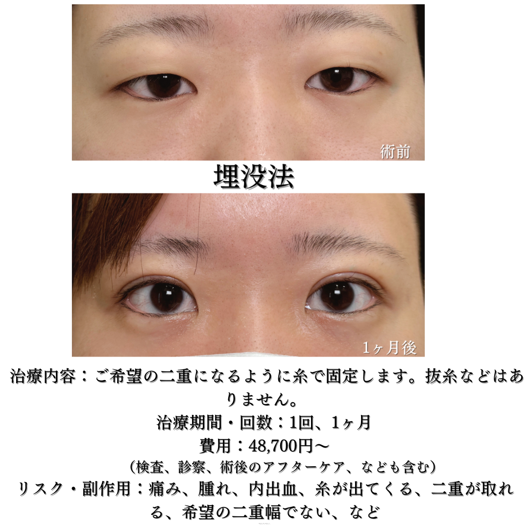 二重埋没法の症例です💁‍♀️