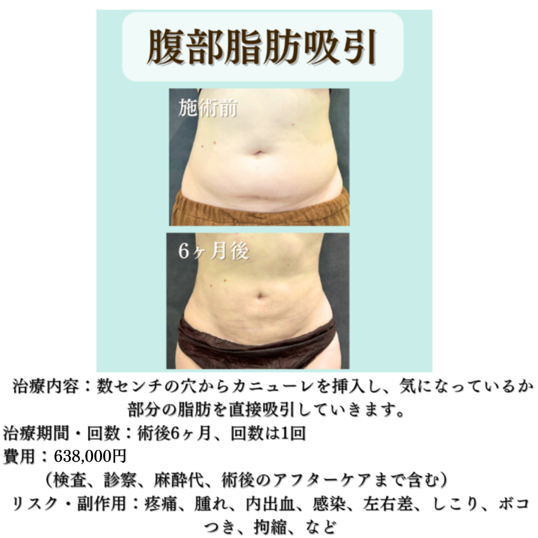 腹部脂肪吸引の症例です💁‍♀️