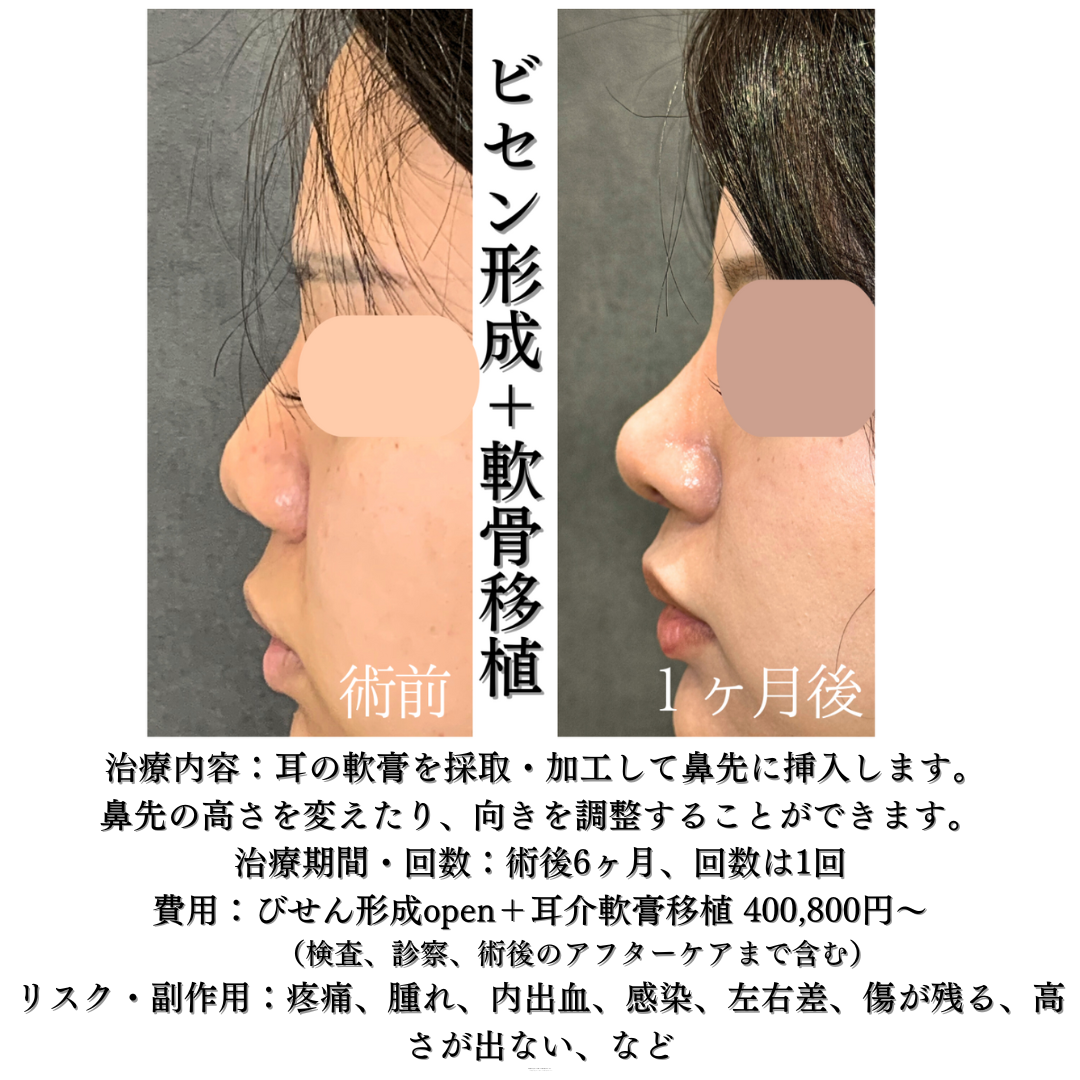💎ビセン形成＋軟骨移植の症例です💎