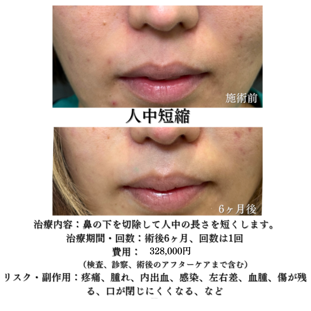 人中短縮の症例です💁