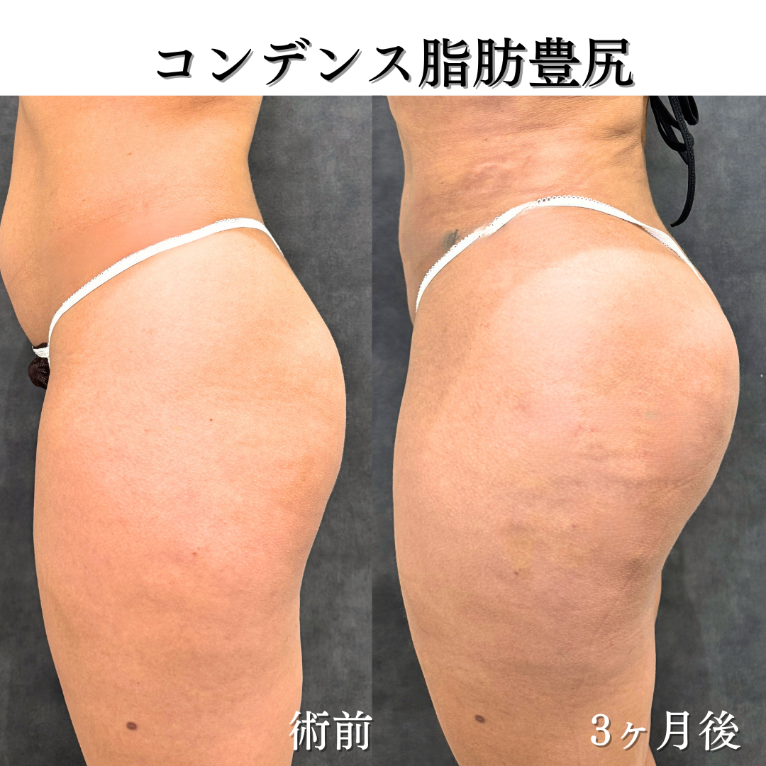 コンデンス脂肪豊尻（BBL）の症例です💡