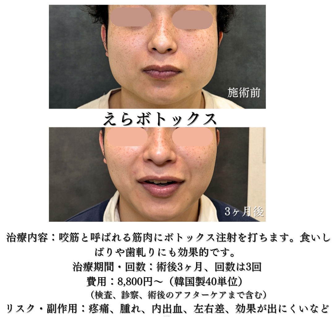 えらボトックスの症例です💡
