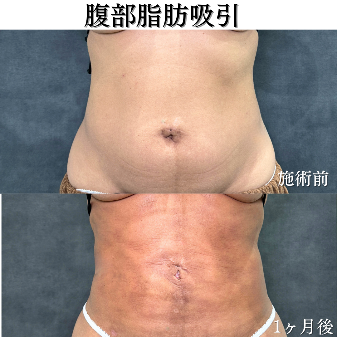 腹部脂肪吸引の症例です💁♀️