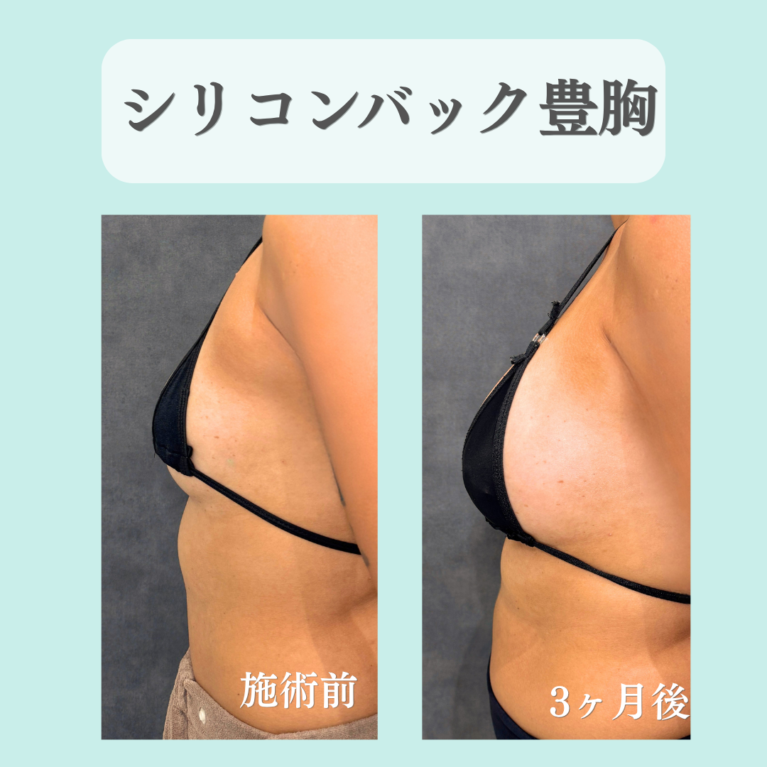 バック豊胸の症例です☺️