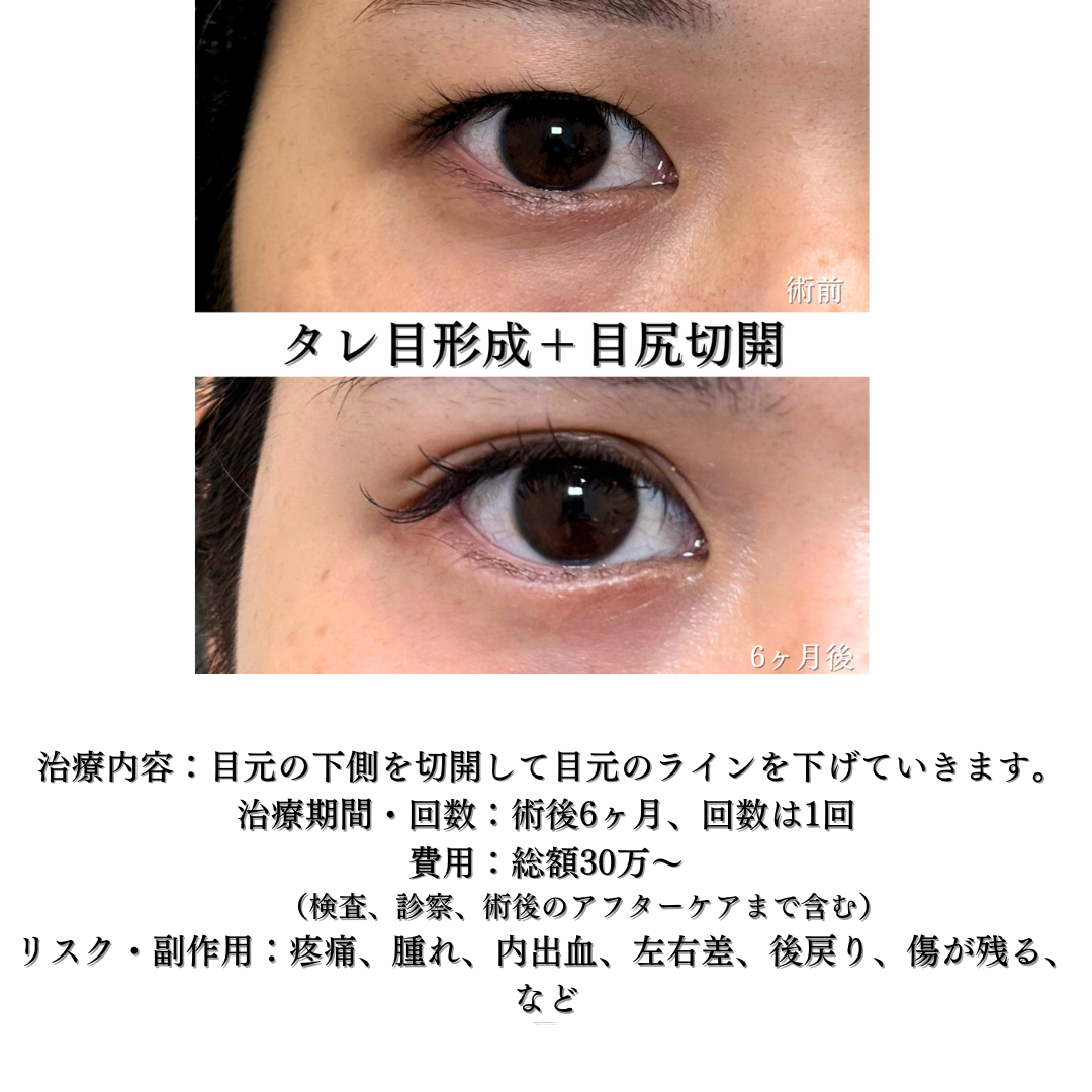 右目のグラマラス形成の症例です💡