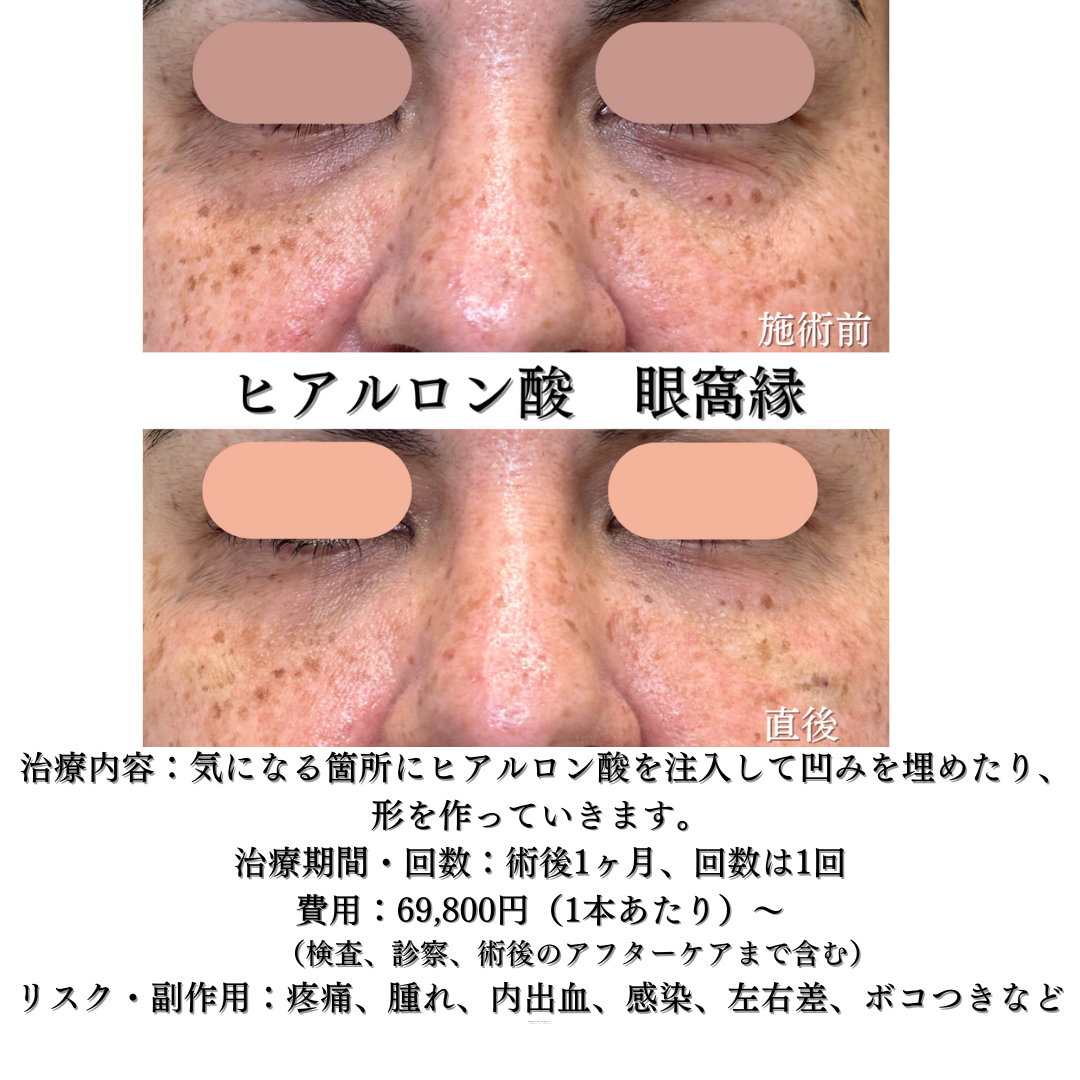 眼科縁ヒアルロン酸の症例です💡
