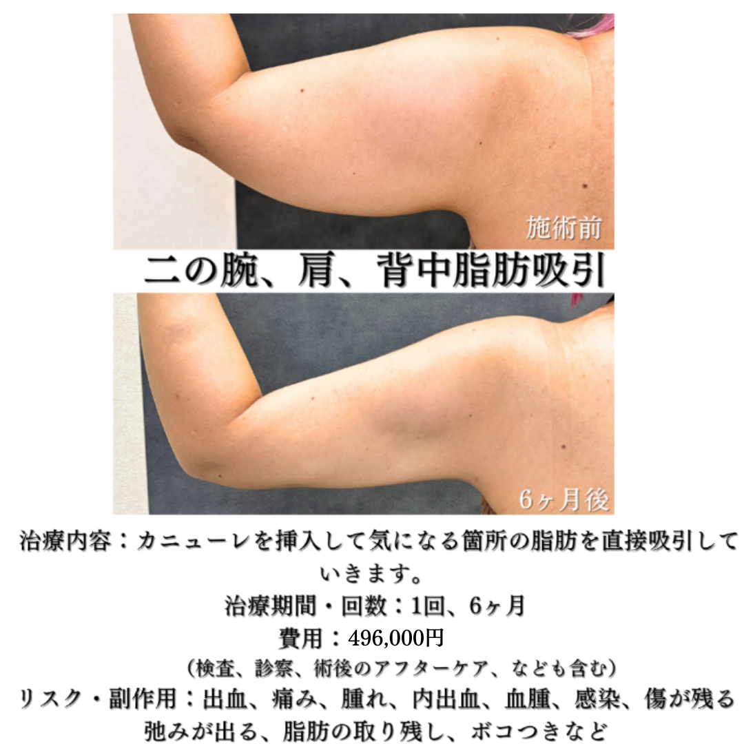 二の腕、肩、背中の脂肪吸引の症例です💁‍♀️