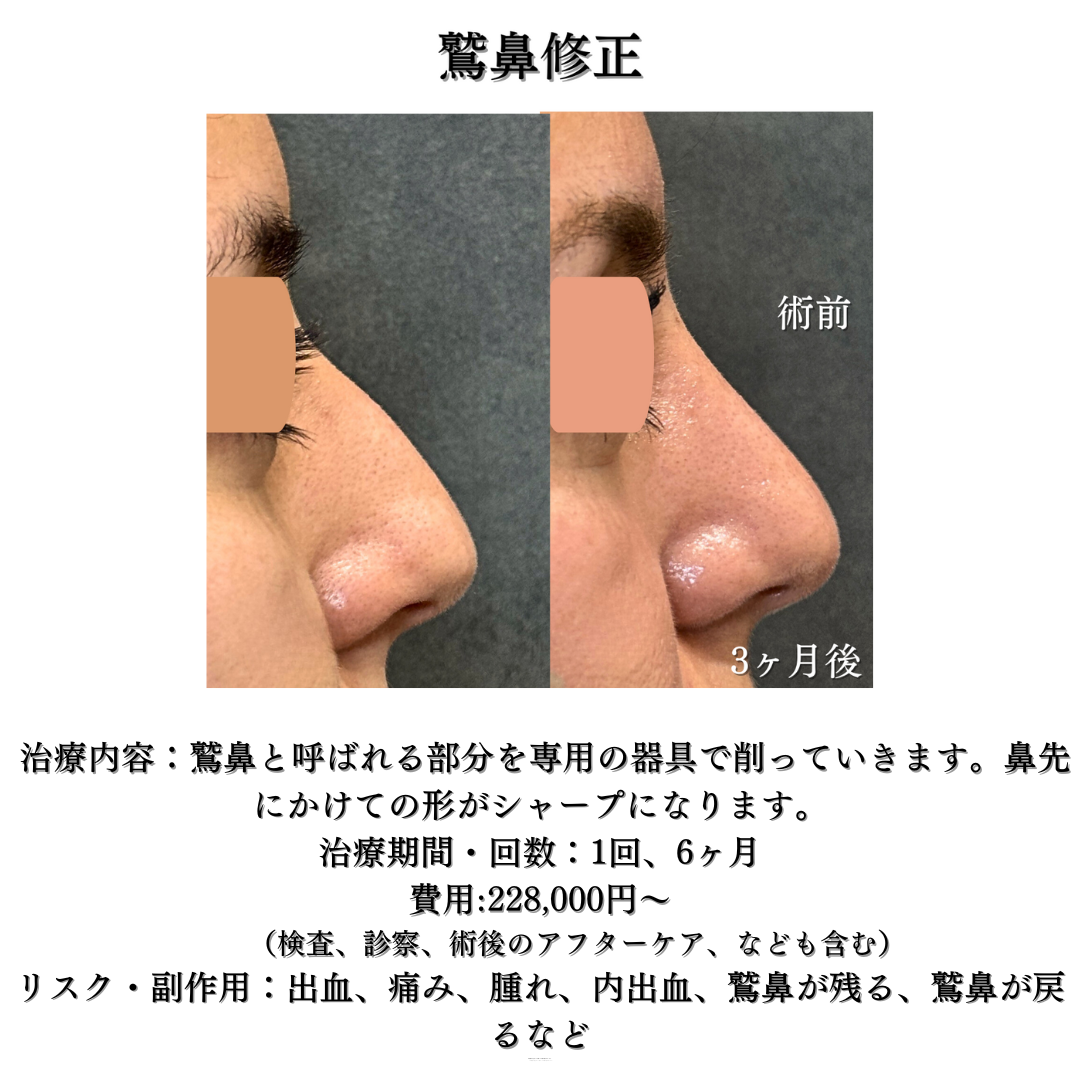 わし鼻修正の症例です💁